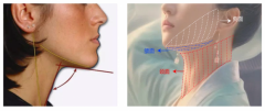 香蜜丽格下颌缘系列之一｜双波长激光Fotona4DPro如何打造完美下颌线？