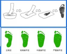 孩子有扁平足 需要穿着矫正鞋进行干预吗
