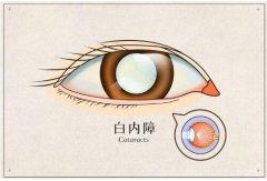 这篇文章告诉你 白内障手术晶体怎么选择