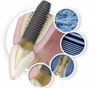 牙科患者福音 Astra种植系统锥形封闭连接设计 让种植牙更美观