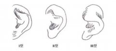 中国小耳畸形医生联盟互助社科普：小耳畸形的症状有哪些 ？