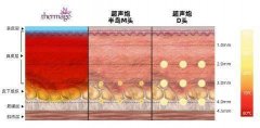 半岛超声炮值得冲吗？热玛吉超声炮哪个除皱效果更好