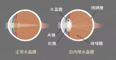 白内障患者必看！上海眼科院长教你如何选出适合自己的人工晶体