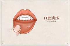 牙龈肿痛、口腔溃疡可用仲景黄连上清丸