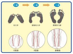 低龄宝宝出现O型腿是正常现象，矫正鞋干预需综合判断