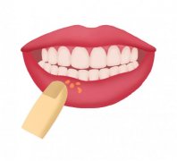 反复口腔溃疡，用草方清火牙膏效果好吗？