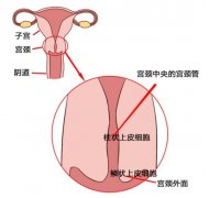“宫颈糜烂”不是病，依旧需要重视治疗——四川明欣药业课堂