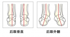 专业矫正产品，爱矫健科学干预孩子足外翻