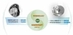 辽宁爱尔眼科医院开展超声睫状体成形术（UCP），开创青光眼手术新时代